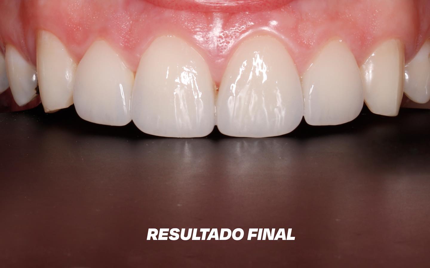 carillas-aspecto-natural